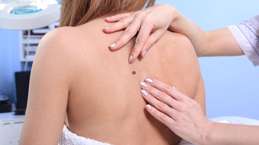 Luomi yksinään ei ole merkki ihosyövästä. Luomia on olemassa montaa eri tyyppiä ja ne ilmaantuvat kehoon monesta eri syystä. Kuvituskuva.