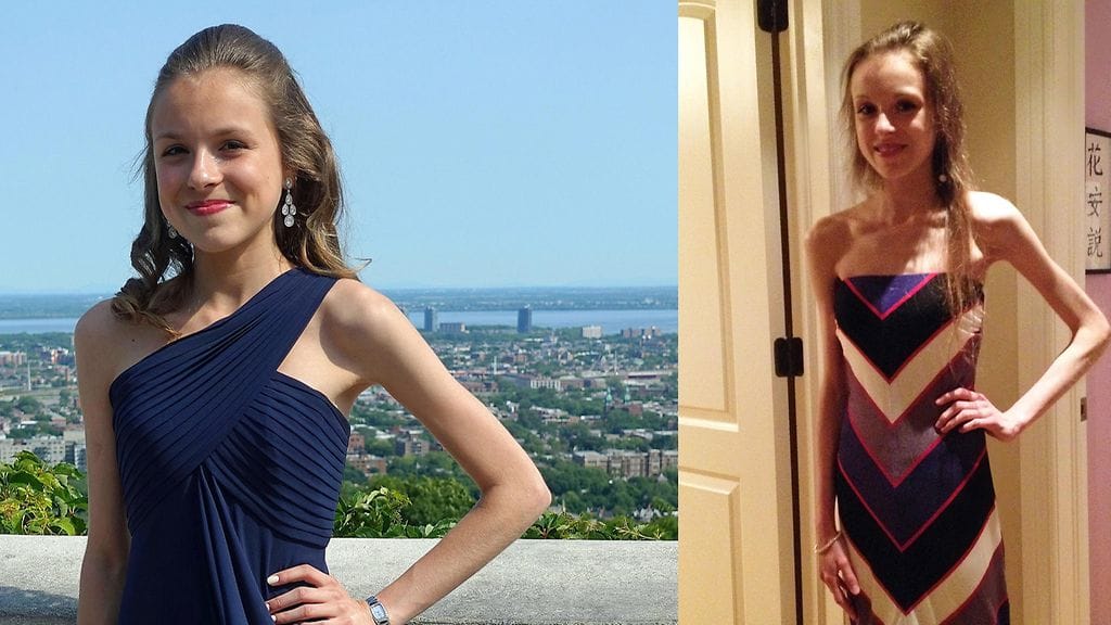 Alice Clarke nyt (vas.) ja juuri toipumisprosessin alettua (oik.)