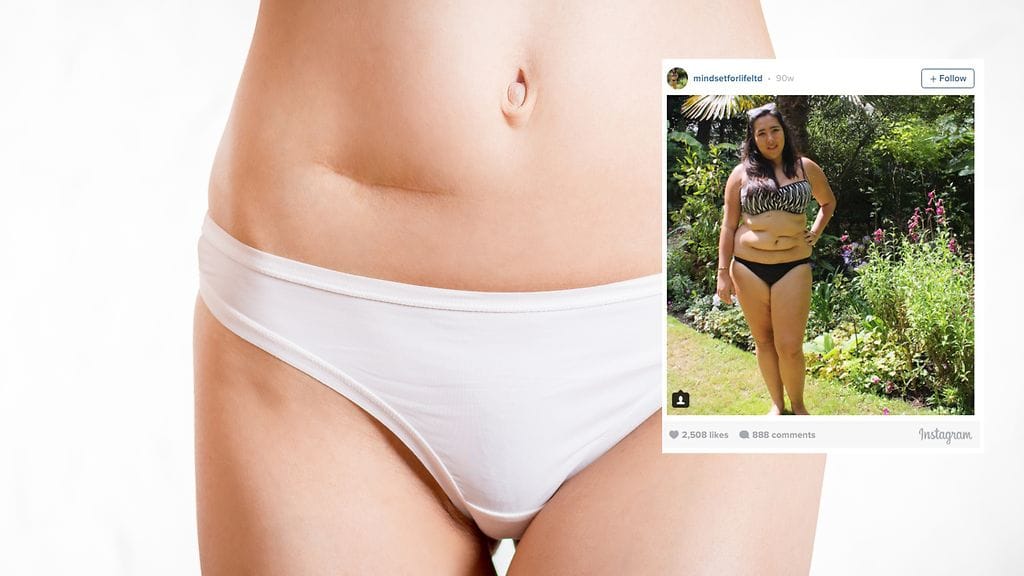 Nuori nainen toivoo, ettei yksikään meistä antaisi arpien rajoittaa elämää.