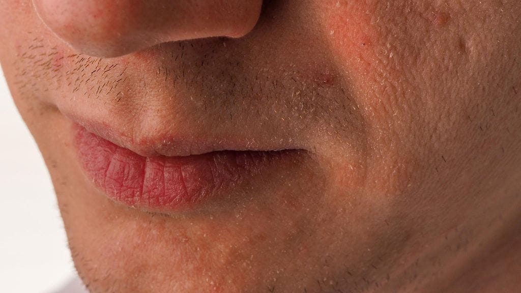 Pakkanen voi kuivattaa ihon pahasti.