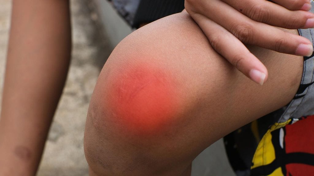 Jos polven paukkumiseen liittyy kipua, turvotusta tai nivelen epävakautta on syytä hakeutua lääkäriin.