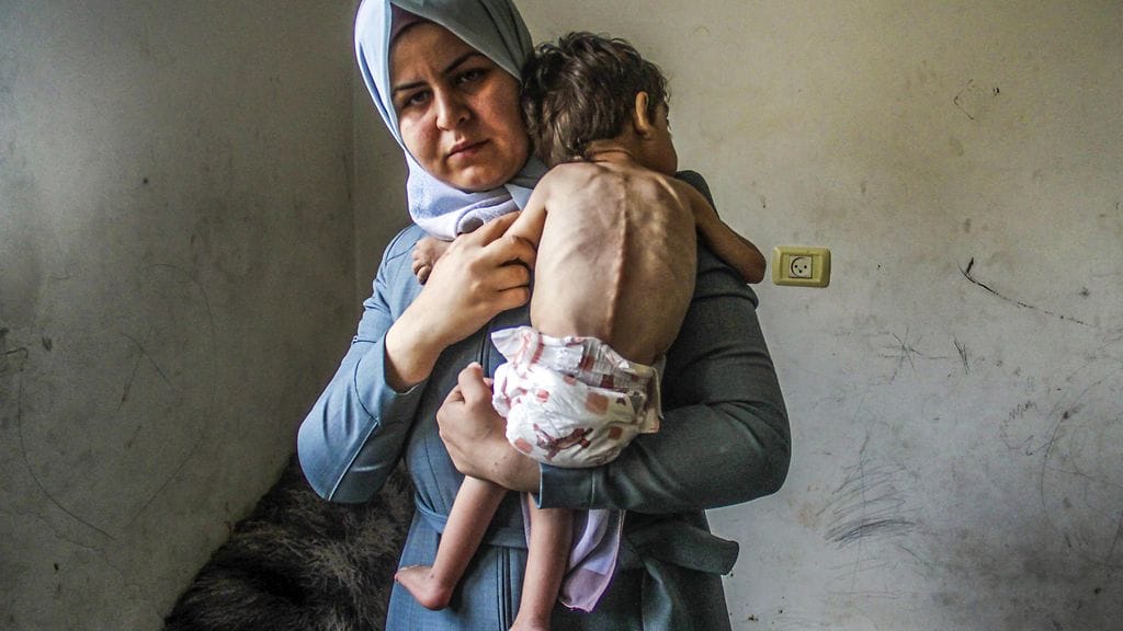 Aliravitsemuksesta kärsivä kolmevuotias lapsi kamppaili eloonjäämisestä Gazan pohjoisosissa lokakuussa.